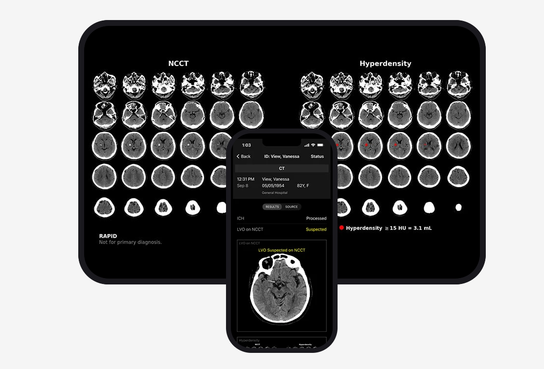 RapidAI Secures $75M for AI-Driven Stroke Care Solutions